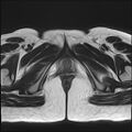 Bilateral ovarian endometriomas (Radiopaedia 87085-103347 Axial T2 23).jpg