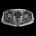 Bilateral ovarian fibroma (Radiopaedia 44568-48293 Axial T1 21).jpg