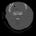 Bilateral perched facets with cord injury (Radiopaedia 45587-49713 Axial bone window 34).jpg