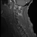 Bilateral perched facets with cord injury (Radiopaedia 45587-49714 Sagittal T1 2).jpg