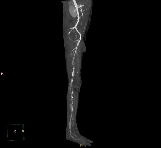 File:Bilateral superficial femoral arterial occlusion (Radiopaedia 25682-25857 3D MIP 7).jpg