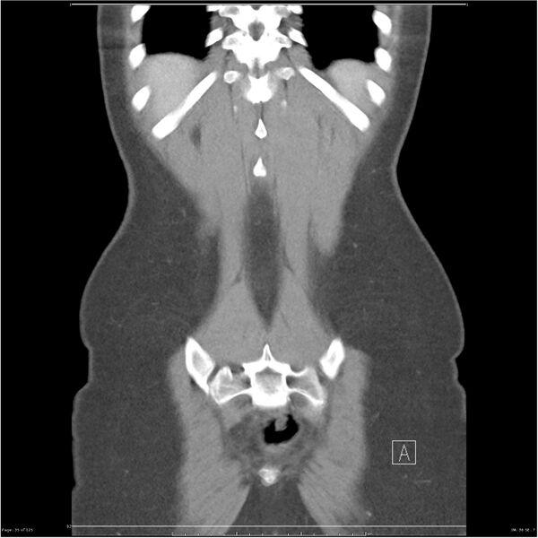 File:Bilateral ureteritis and cystitis (Radiopaedia 25340-25594 B 35).jpg