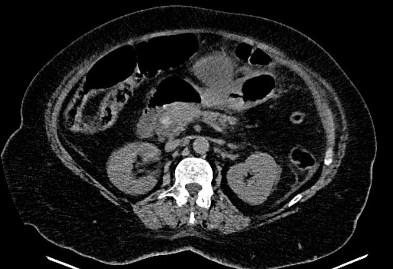 File:Biliary pancreatitis (Radiopaedia 72289-82823 Axial non-contrast 112).jpg