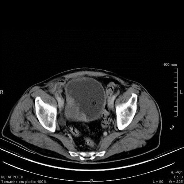 File:Bladder squamous cell carcinoma (Radiopaedia 14130-13984 B 7).jpg