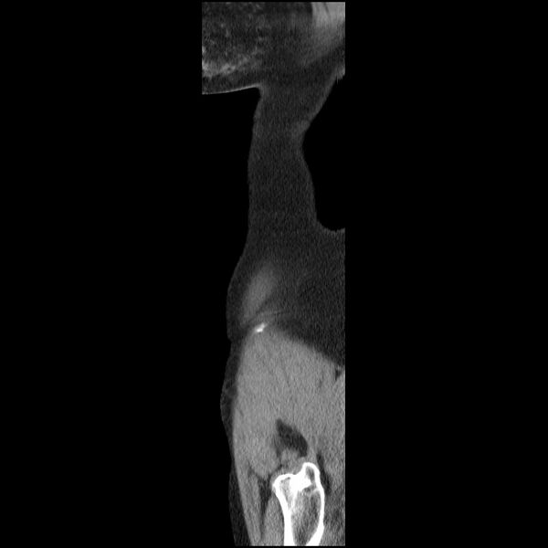 File:Bladder tumor detected on trauma CT (Radiopaedia 51809-57609 E 72).jpg