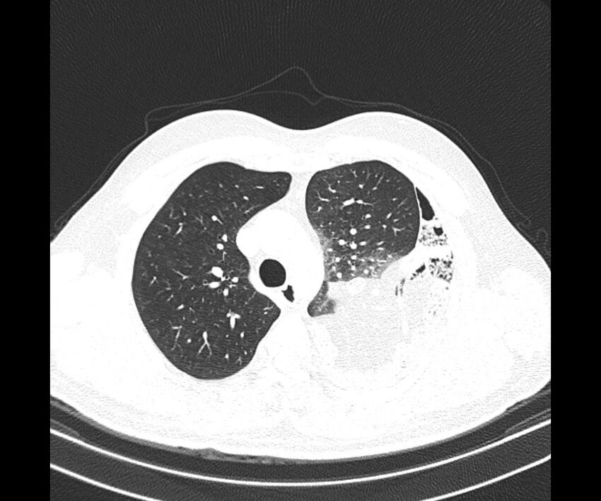 Bochdalek hernia - adult presentation (Radiopaedia 74897-85925 Axial lung window 13).jpg