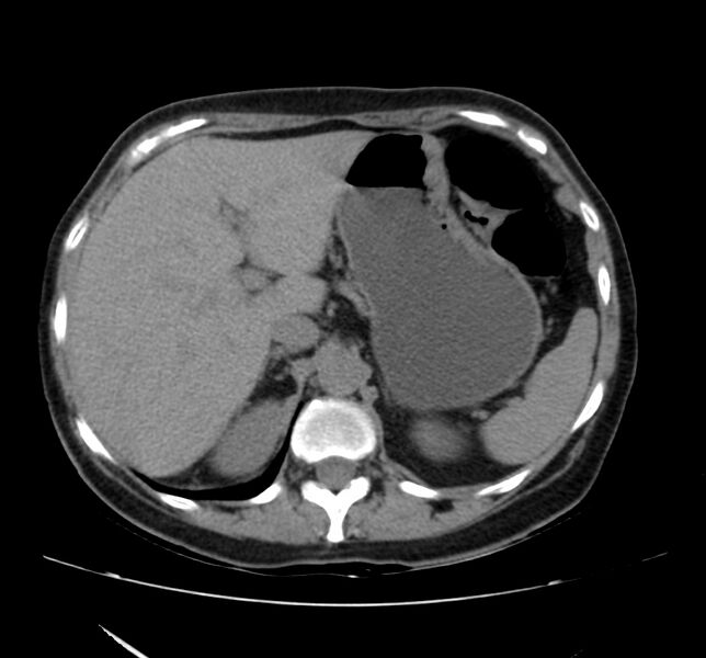 File:Bosniak renal cyst - type IV (Radiopaedia 22929-22953 Axial non-contrast 12).jpg