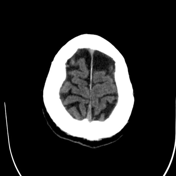 File:Brain Pantopaque remnants (Radiopaedia 78403-91048 Axial non-contrast 81).jpg
