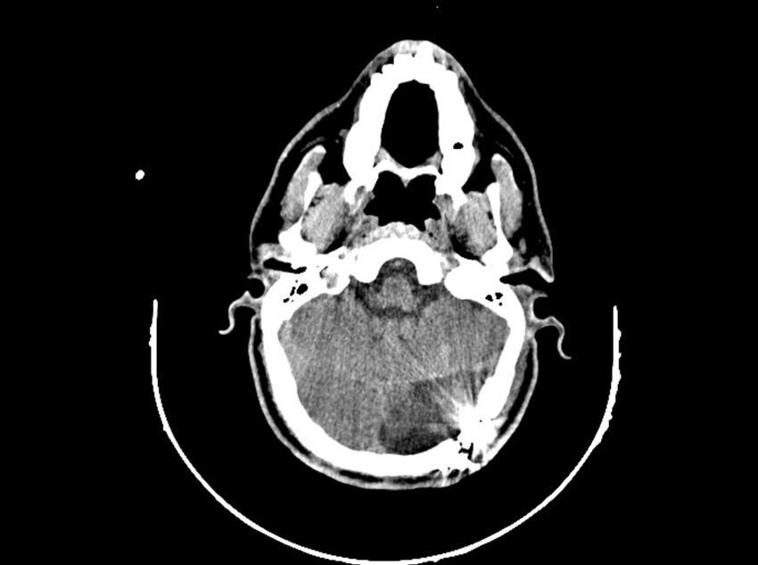 Brain injury by firearm projectile (Radiopaedia 82068-96088 A 82).jpg