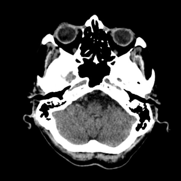 File:Brain metastases from lung cancer (Radiopaedia 27849-28092 Axial non-contrast 10).jpg