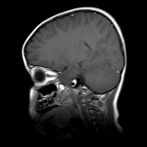 File:Brainstem ganglioglioma (Radiopaedia 10763-11224 Sagittal T1 C+ 7).jpg