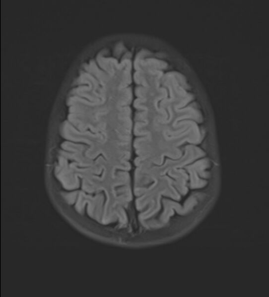 File:Brainstem glioma (Radiopaedia 70548-80674 Axial FLAIR 20).jpg