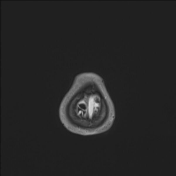 File:Brainstem glioma (Radiopaedia 70548-80674 Axial T1 C+ 150).jpg