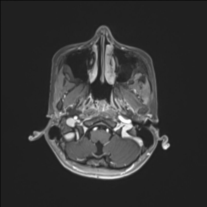 Brainstem glioma (Radiopaedia 70548-80674 Axial T1 C+ 26).jpg