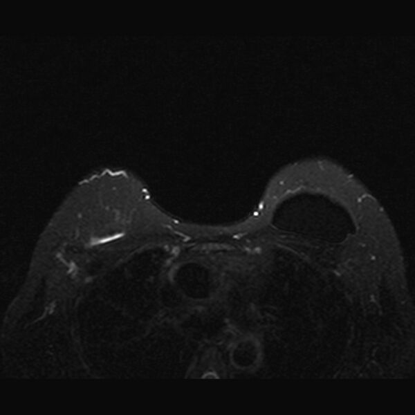 File:Breast implants - MRI (Radiopaedia 26864-27035 T2 SPAIR 40).jpg