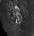Broad ligament leiomyoma (Radiopaedia 81634-95516 G 9).jpg