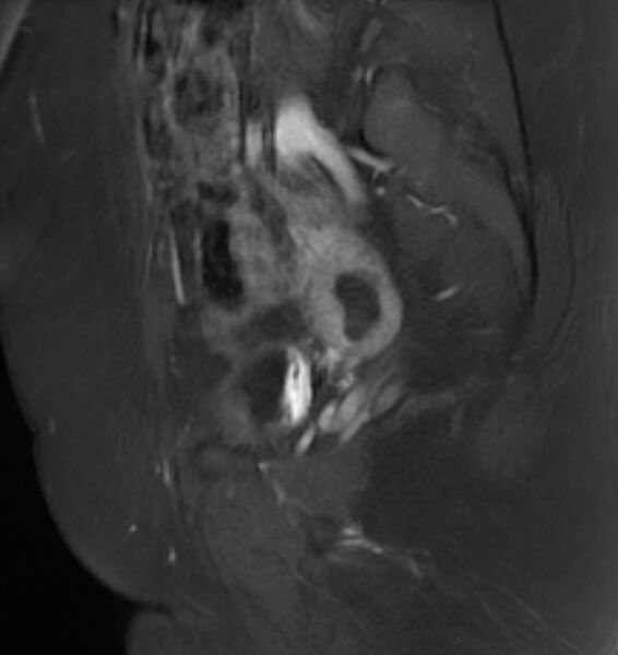 File:Broad ligament leiomyoma (Radiopaedia 81634-95516 G 9).jpg