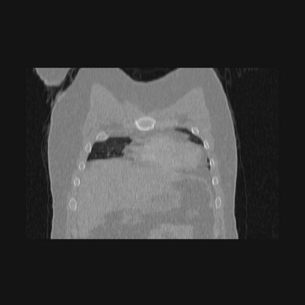 File:Bronchial atresia (Radiopaedia 60685-68439 Coronal lung window 65).jpg