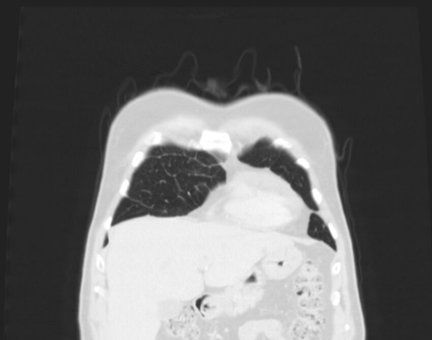 Bronchogenic carcinoma with lymphangitic spread (Radiopaedia 29002-29357 Coronal lung window 5).jpg