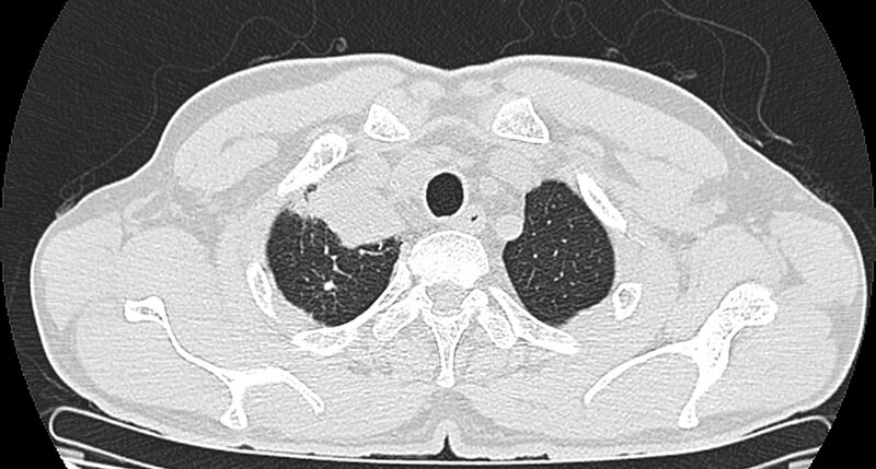File:Bronchogenic carcinoma with superior vena cava syndrome (Radiopaedia 36497-38054 Axial lung window 11).jpg