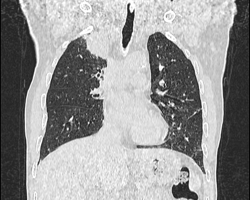 Bronchogenic carcinoma with superior vena cava syndrome (Radiopaedia 36497-38054 Coronal lung window 25).jpg