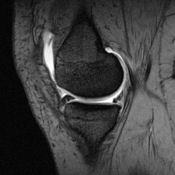 File:Bucket handle tear - medial meniscus (Radiopaedia 79028-91942 D 18).jpg