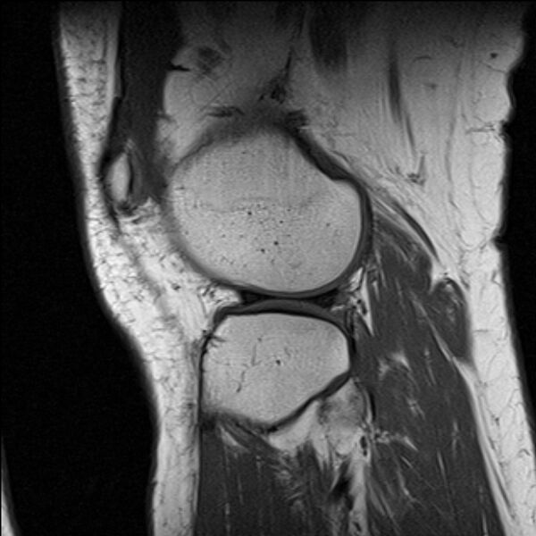 File:Bucket handle tear - medial meniscus (Radiopaedia 79028-91942 Sagittal T1 5).jpg