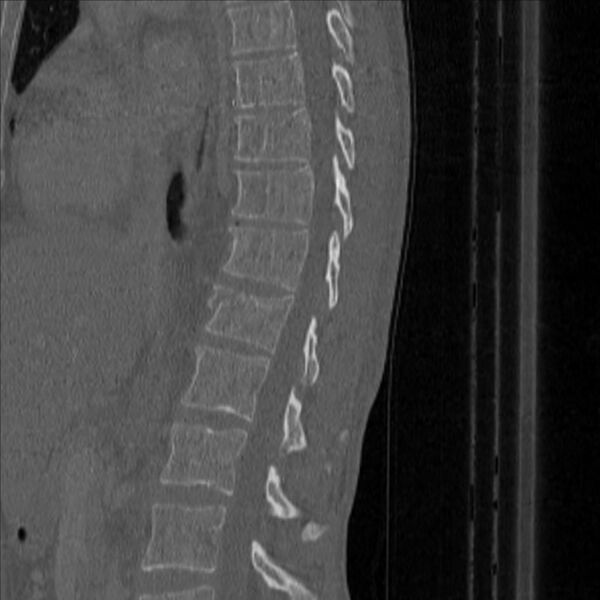File:Bulging of paraspinal line in traumatic thoracal spinal compression fracture (Radiopaedia 29221-35872 Sagittal bone window 30).jpg