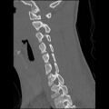 C5 facet fracture (Radiopaedia 58374-65499 Sagittal bone window 43).jpg