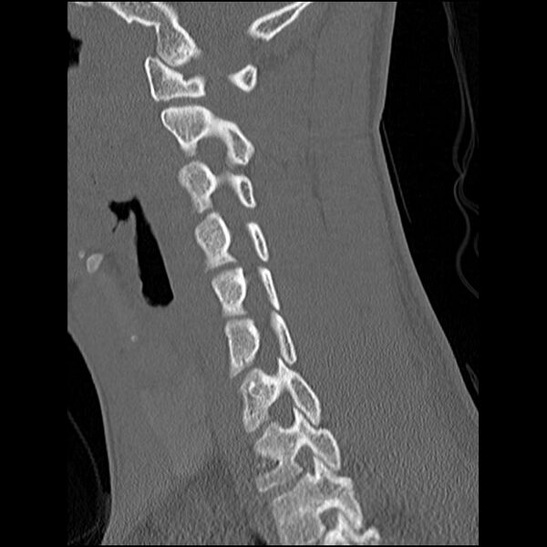 File:C5 facet fracture (Radiopaedia 58374-65499 Sagittal bone window 43).jpg