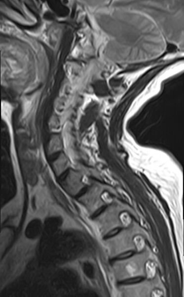 File:Calcified meningioma - cervical canal (Radiopaedia 70136-82468 Sagittal T2 10).jpg