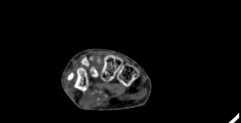 File:Calcifying aponeurotic fibroma (Radiopaedia 88423-105064 B 103).jpg