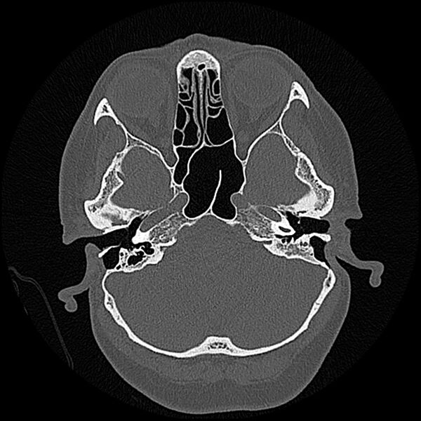 File:Canal up mastoidectomy (Radiopaedia 78108-90638 Axial bone window 61).jpg