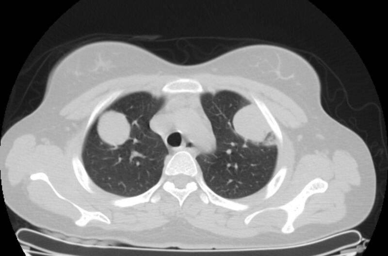 File:Cannonball metastases - uterine choriocarcinoma (Radiopaedia 70137-80173 Axial lung window 12).jpg
