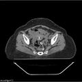 Carcinoma cervix- brachytherapy applicator (Radiopaedia 33135-34173 Axial non-contrast 23).jpg