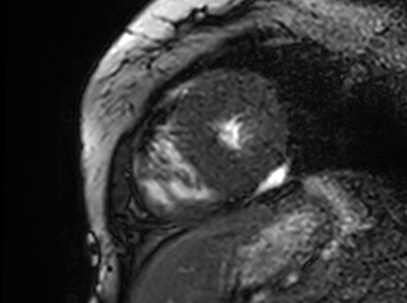 File:Cardiac amyloidosis (Radiopaedia 61600-69579 Short axis bSSFP 77).jpg
