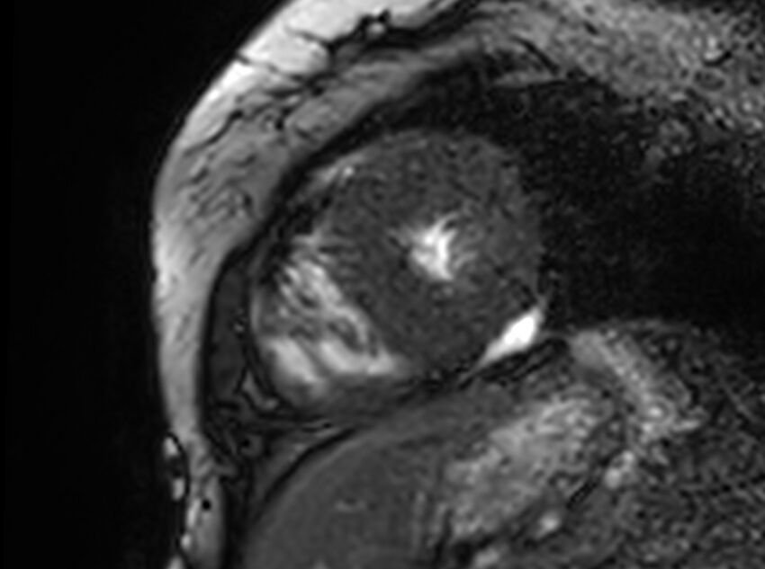 Cardiac amyloidosis (Radiopaedia 61600-69579 Short axis bSSFP 77).jpg