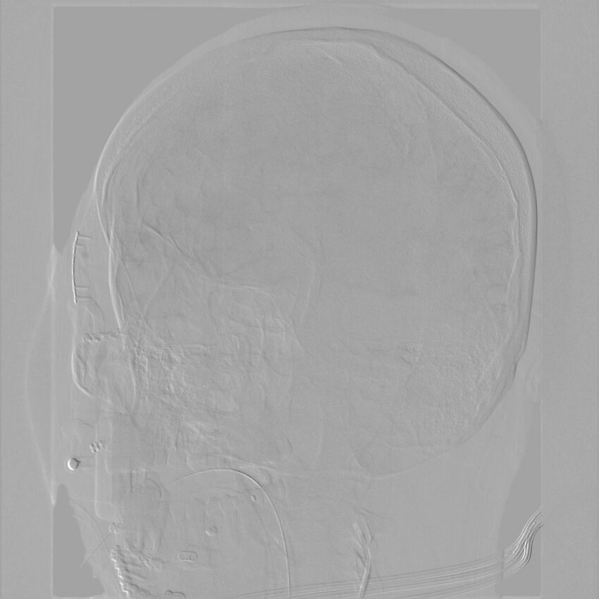 Caroticocavernous fistula - direct (Radiopaedia 61660-69666 Oblique Left ICA 39).jpg