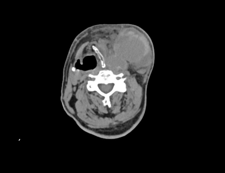 File:Carotid artery pseudoaneurysm (Radiopaedia 84030-99259 Axial non-contrast 23).jpg