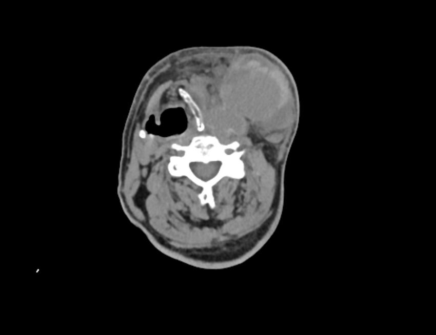 Carotid artery pseudoaneurysm (Radiopaedia 84030-99259 Axial non-contrast 23).jpg