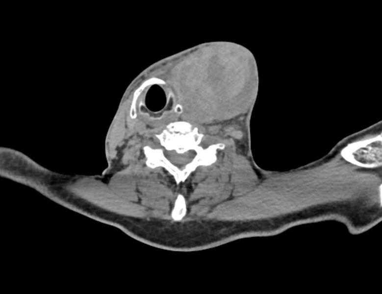 File:Carotid artery pseudoaneurysm (Radiopaedia 84030-99259 Axial non-contrast 36).jpg