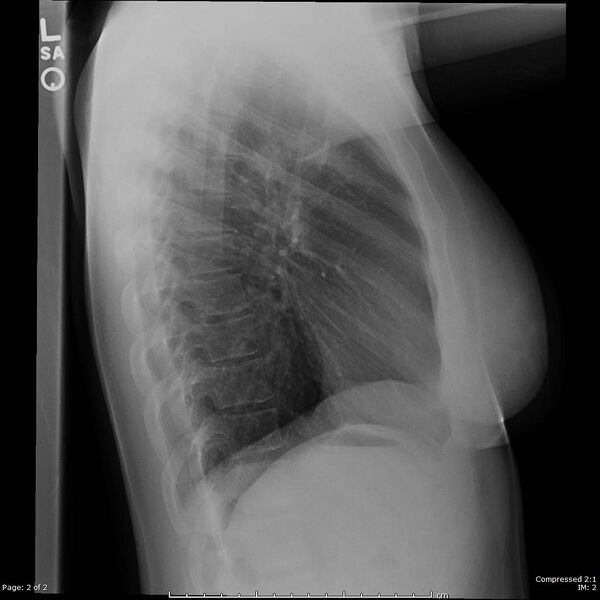 File:Catamenial pneumothorax (Radiopaedia 54382-60602 Lateral 1).jpg