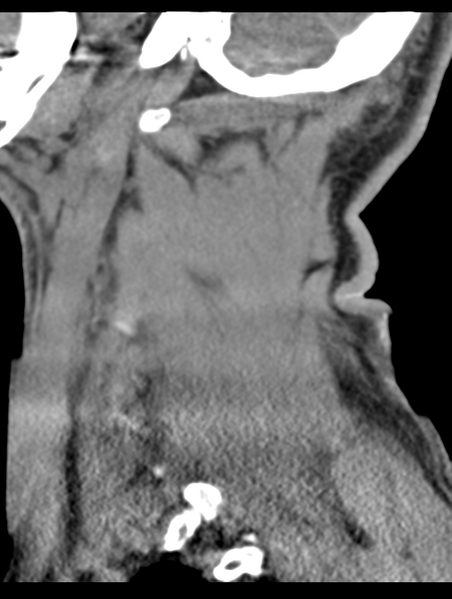 File:Cavernoma of cervical cord (Radiopaedia 50838-56346 B 67).png