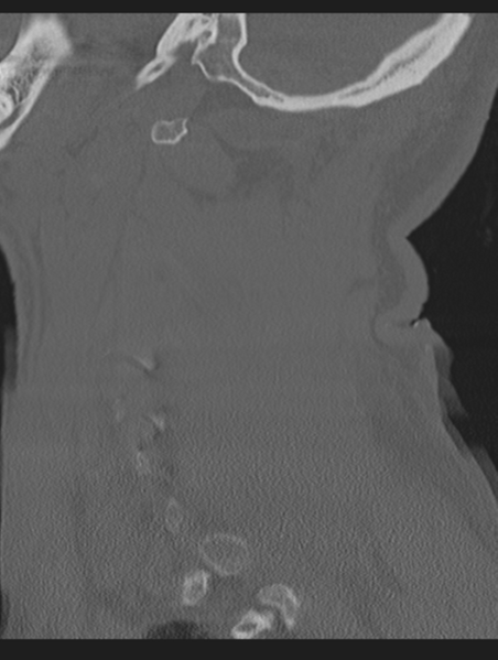 File:Cavernoma of cervical cord (Radiopaedia 50838-56346 Sagittal bone window 65).png