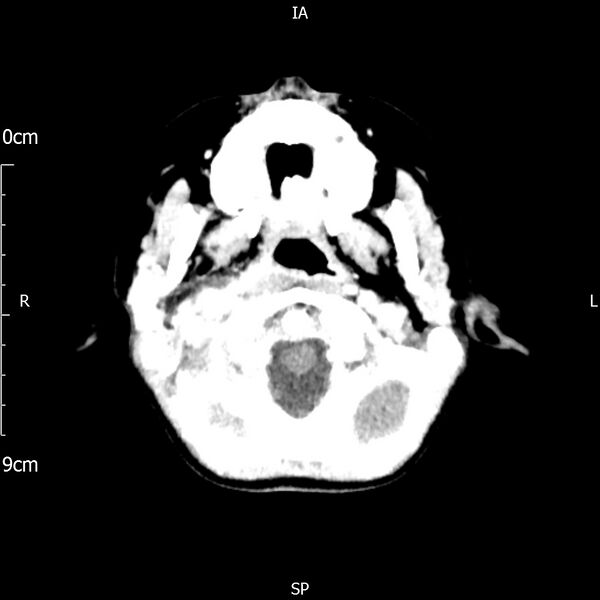 File:Cavernous sinus thrombosis (Radiopaedia 79414-92510 Axial Brain 45).jpg