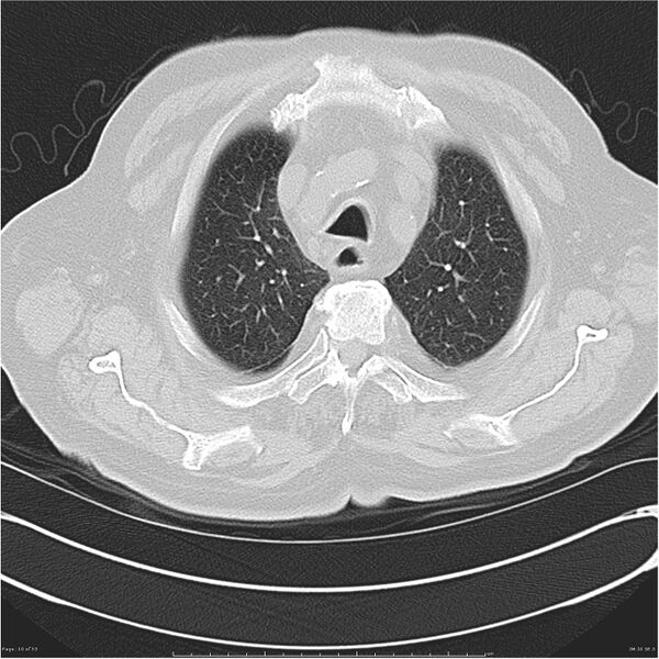File:Cavitating left lower lobe lesion - squamous cell lung cancer (Radiopaedia 27749-28176 Axial lung window 10).jpg