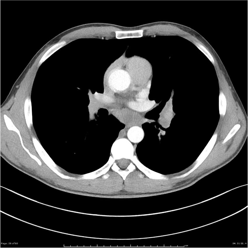 Cavitating lung cancer (Radiopaedia 25796-25945 C+ arterial phase 28).jpg