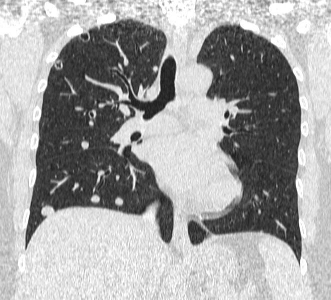 File:Cavitating pulmonary metastases (Radiopaedia 17796-17555 Coronal lung window 13).jpg