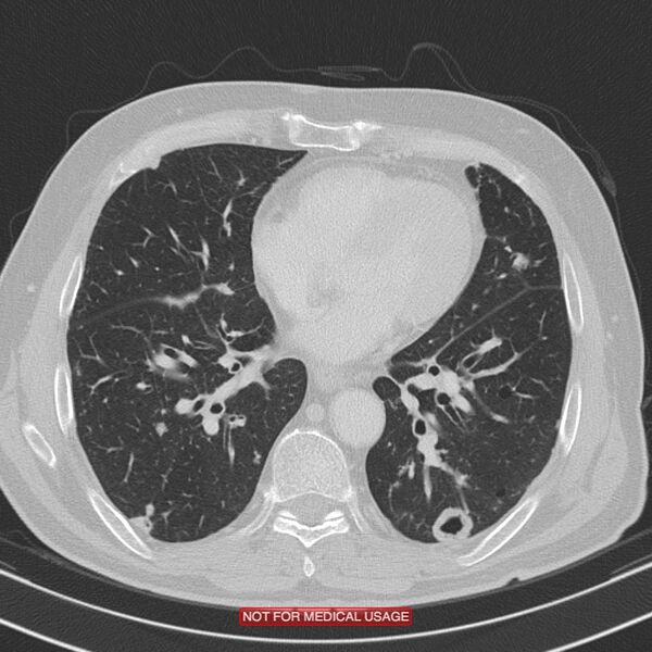 File:Cavitating pulmonary metastases (Radiopaedia 24920-25184 Axial lung window 15).jpg