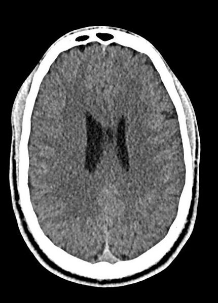 File:Cavum septum pellucidum and cavum vergae (Radiopaedia 77797-90060 Axial Brain Window 67).jpg